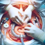 Gestire un’ileostomia: consigli utili e informazioni importanti